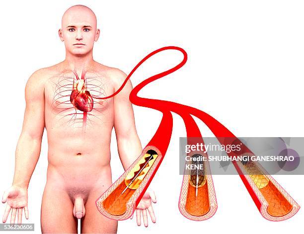 angioplasty, computer artwork. - stent stock pictures, royalty-free photos & images