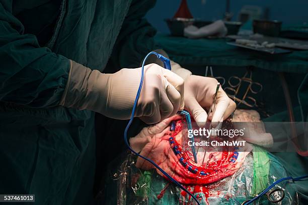 neurosurgeon remove brain tumour - neurosurgery stock-fotos und bilder