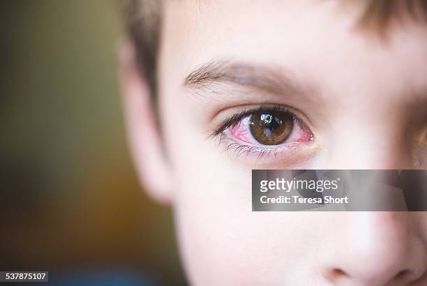 boy with conjunctivitis or pink-eye - red eye stock-fotos und bilder