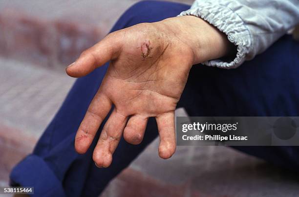 child worker who lost a finger in a labor accident - trabalho infantil imagens e fotografias de stock