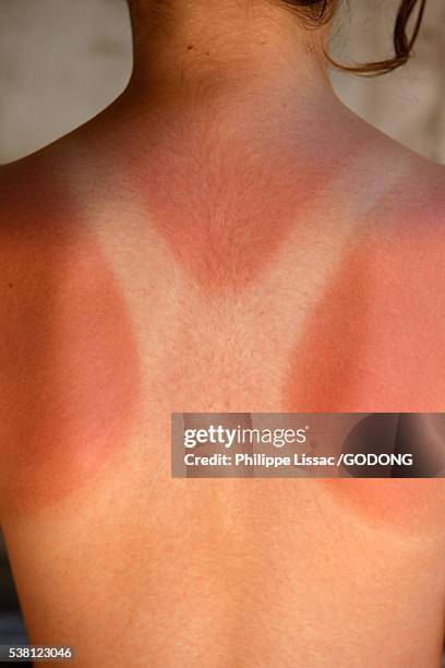 child's sunburnt skin - rash stock pictures, royalty-free photos & images