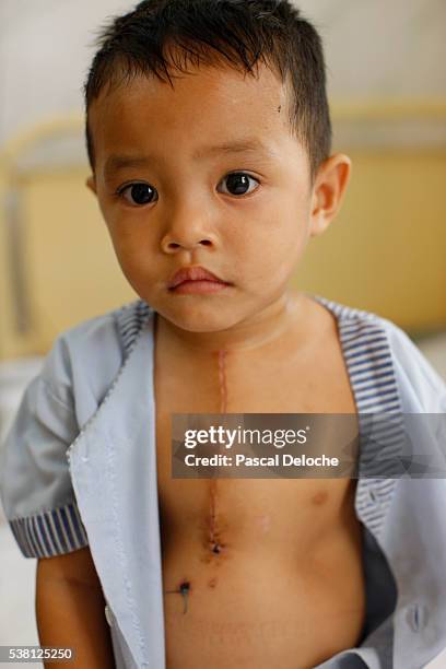 children's ward in phnom penh cardiac hospital - heart surgery scar stock pictures, royalty-free photos & images