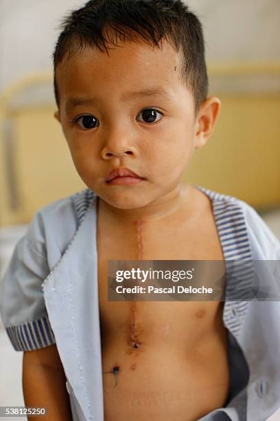children's ward in phnom penh cardiac hospital - heart surgery scar 個照片及圖片檔