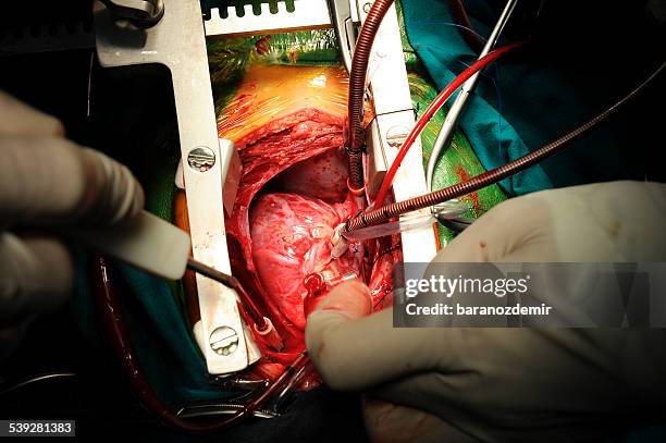 pediatric heart surgery, close-up - heart surgery stock pictures, royalty-free photos & images