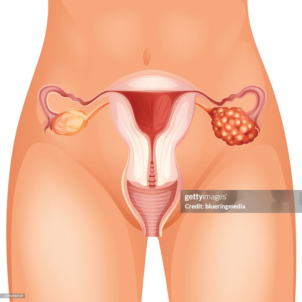 Ovarian cancer diagram in detail