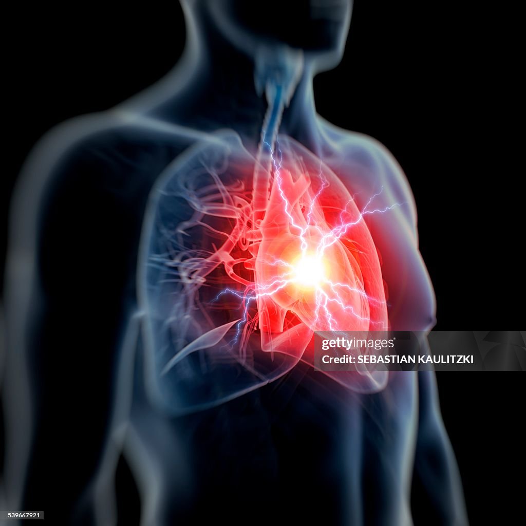 Human heart attack, illustration