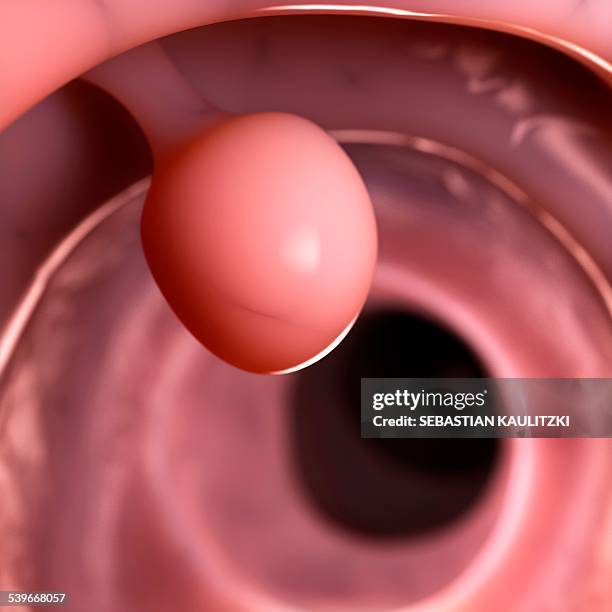 Javert Polyp 75 Colon Polyp Stock Photos, High-Res Pictures, and Images - Getty Images