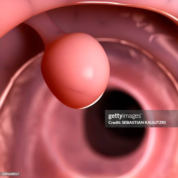 polyp in the human colon, illustration - colon polyp stock illustrations