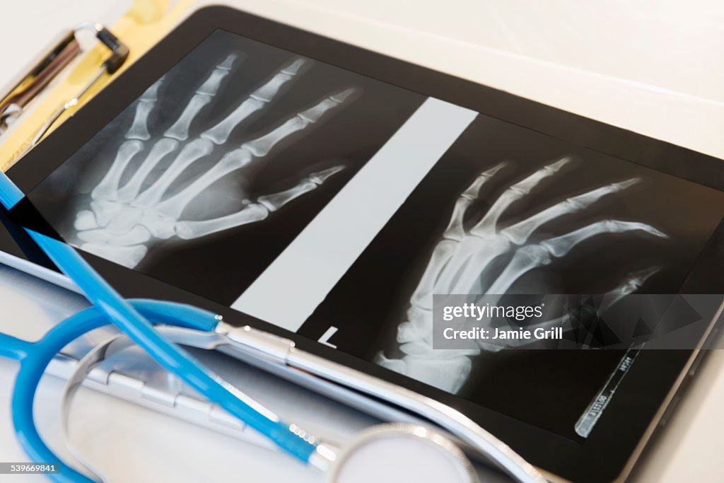 X-ray of human hand on digital tablet