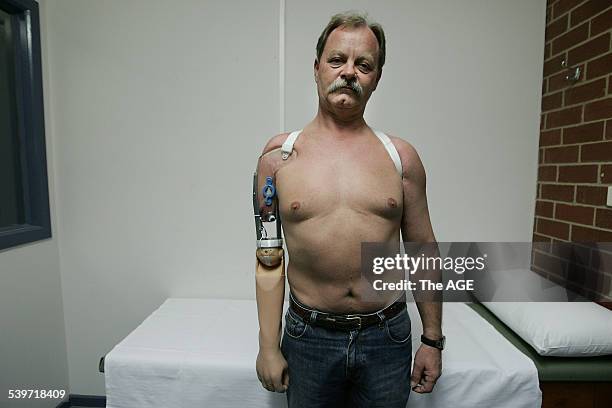 Peter Eberle, the recipient of a new bionic arm, at Caulfield general medical centre, 4 July 2005. The Age Picture by JOE ARMAO