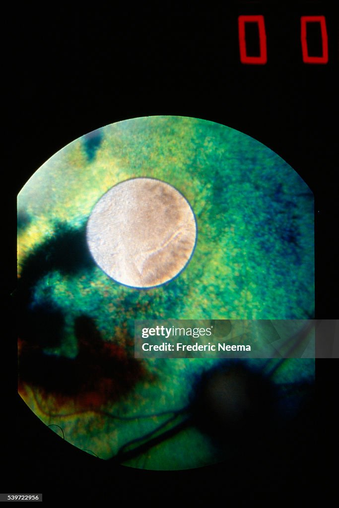 The Bionic Eye