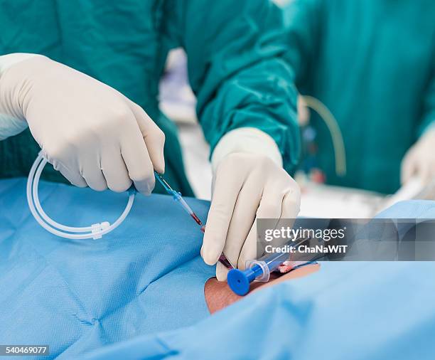 doctor apply guide wire to jugular vein - cateter imagens e fotografias de stock