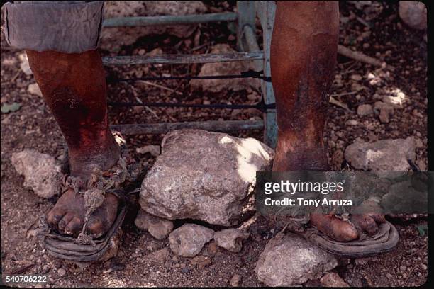 leprotic leg and feet - leprosy fotografías e imágenes de stock