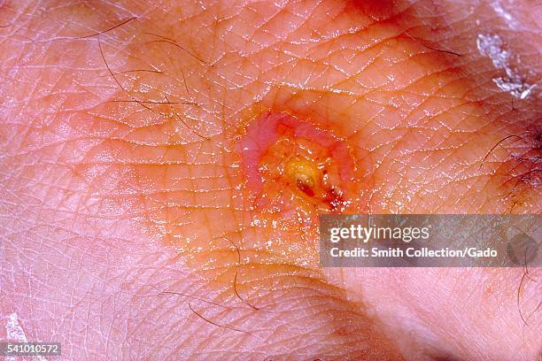 Tularemia lesion on the dorsal skin of right hand, 1963. Symptoms vary depending on how the person was exposed to the disease, and as is shown here,...