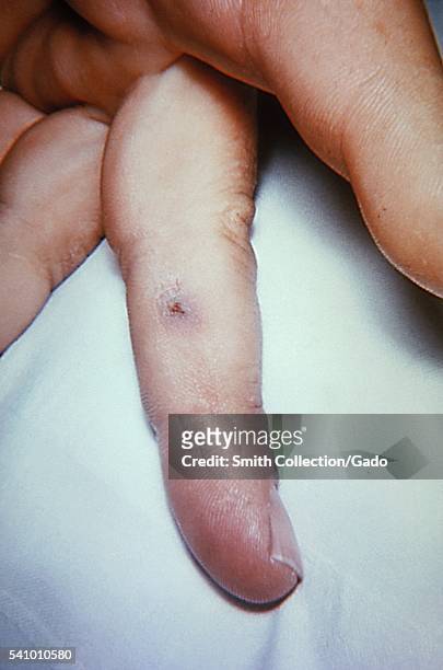 Tularemia lesion on the skin of the left third finger due to Francisella tularensis bacteria, 1963. Symptoms vary depending on how the person was...