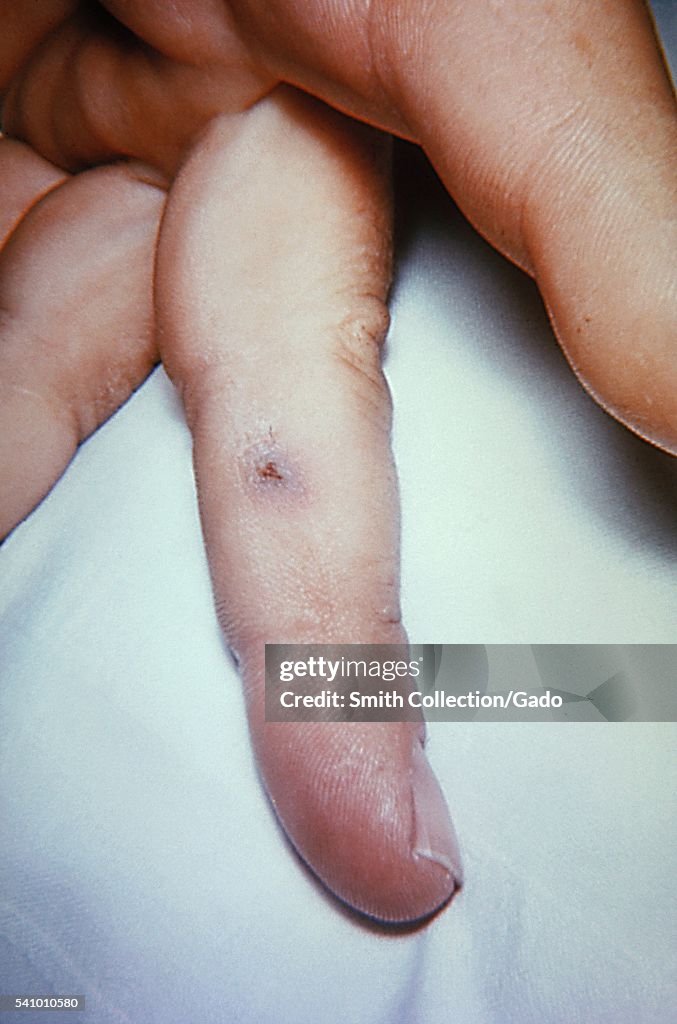 Tularemia Lesion On The Skin Of The Left Third Finger