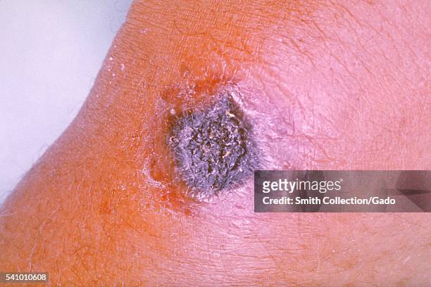 Anthrax lesion on the skin of the forearm caused by the bacterium Bacillus anthracis, 1962. Here the disease has manifested itself as a cutaneous...