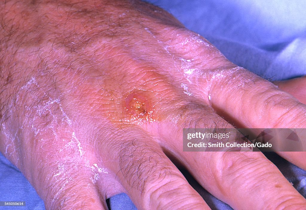 A Tularemia Lesion On The Dorsal Skin Of The Right Hand