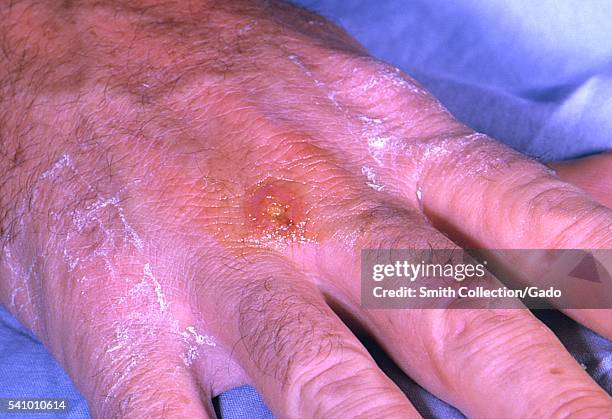 Tularemia lesion on the dorsal skin of the right hand, caused by the bacterium Francisella tularensis, 1963. Symptoms vary depending on how the...