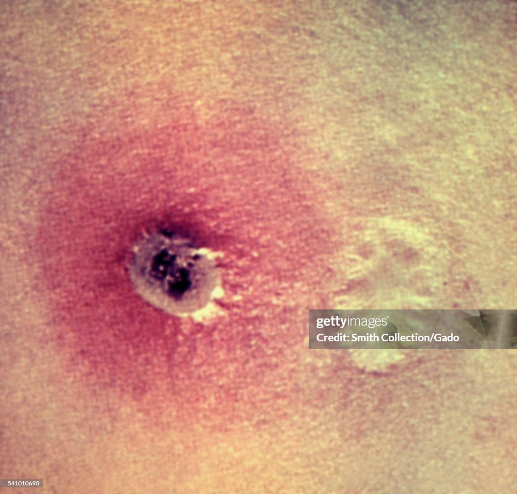 Close-up of the skin reaction at a smallpox vaccination site, 1981 ...