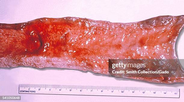 Typhoid fever cholecystitis with an ulceration and perforation of the gallbladder into the jejunum, 1964. Salmonella typhi, the bacterium responsible...