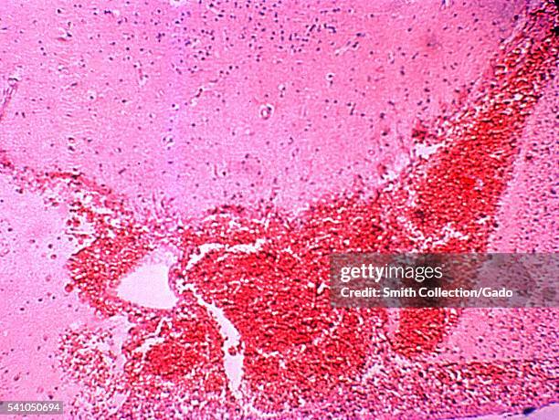 Photomicrograph demonstrating the histopathologic changes in brain tissue due to Salmonella typhi bacteria, 1964. Salmonella septicemia has been...