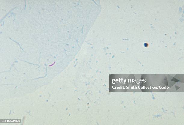 Photomicrograph of Mycobacterium tuberculosis in a sputum smear, using Ziehl-Neelsen acid-fast stain technique, 1971. Infection is passed from one...