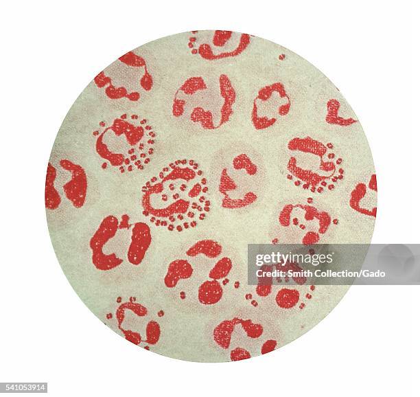 Photomicrograph of Neisseria gonorrhoeae viewed using a Gram-stain technique, 1979. This photomicrograph of N. Gonorrhoeae, a gonococcus, is from a...