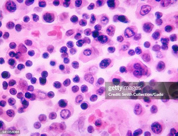 Histopathology of a lymph node in a case of typhoid fever, 1964. After initially being ingested in contaminated food such as shellfish, or water, the...