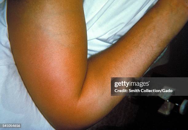 Right elbow of a patient with group B Streptococcus bacteremia, with localized edema and erythema, 1964. Here the GBS bacteria have entered the blood...