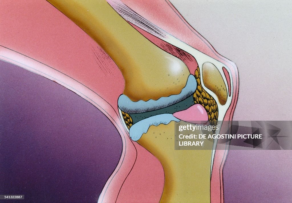 Osteoarthritis, a degenerative disease...