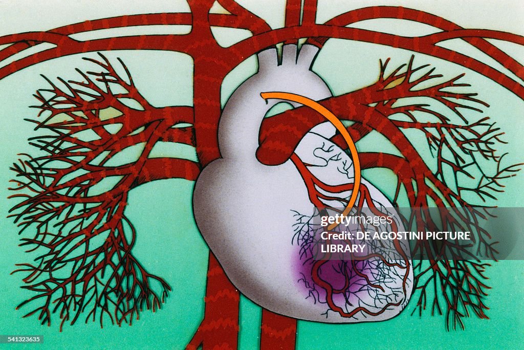 Heart, coronary artery occlusion...