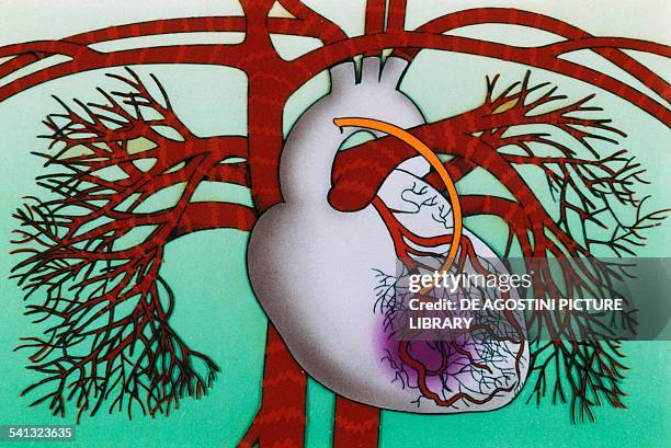 Heart, coronary artery occlusion surgically resolved with the technique of bypass grafting, design.