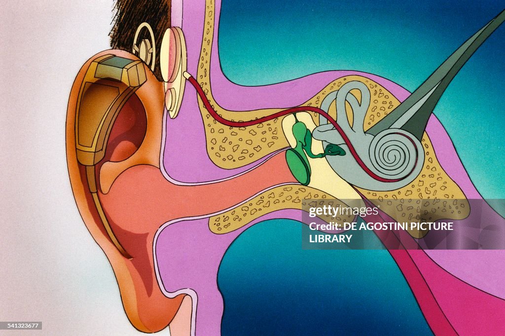 Cochlear implant...