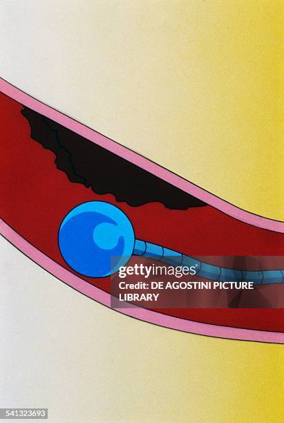 Myocardial infarction, restoring blood flow throught a catheter with inflatable end, design.