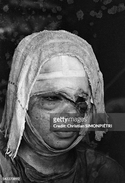 Face of a Vietnamese girl burned by napalm following an American bombing during the Vietnam War.