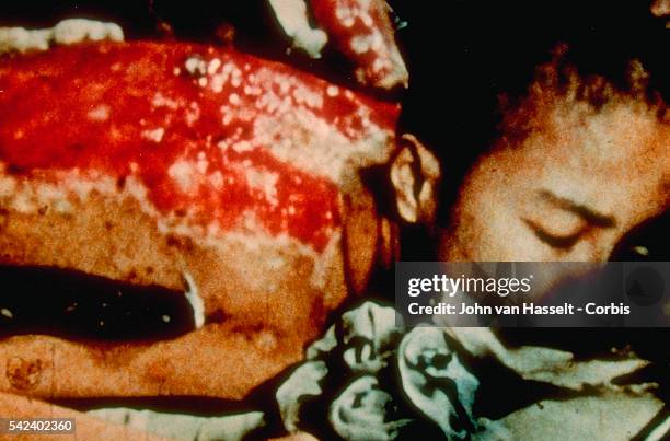 Sumiteru Taniguchi was burned badly by the bomb dropped on Nagasaki. He later recovered and lived to be an old man. | Location: Nagasaki, Kyushu,...