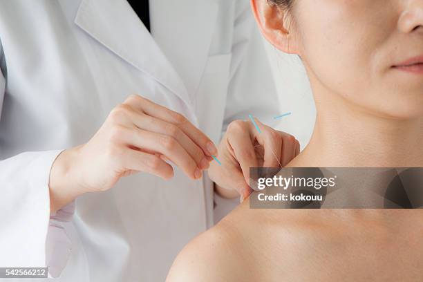 women receiving acupuncture treatment for beauty - acupuncture stockfoto's en -beelden