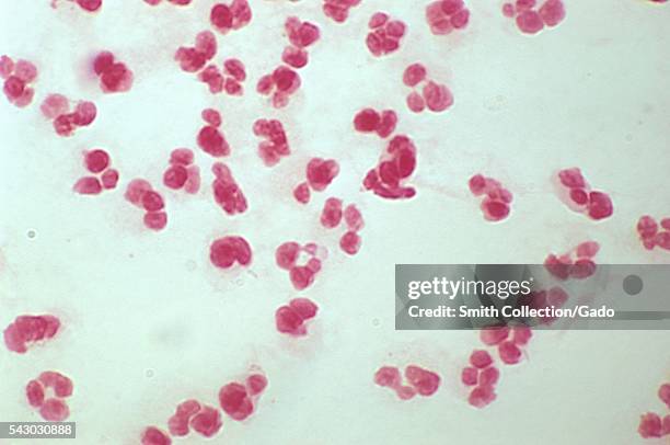 Gram stain, urethral exudate, from male with urethritis, 1974. Note the lack of gram negative intracellular diplococci. Gram-stain technique, which...