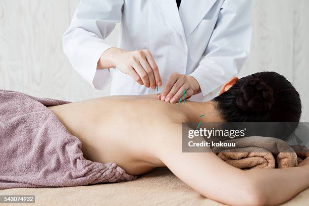 women who are acupuncture back in the clinic - acupuncture stock pictures, royalty-free photos & images