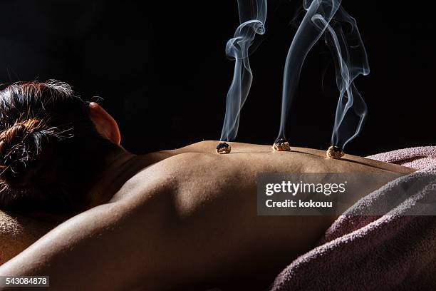 women receiving moxibustion treatment to cure back pain - acupuncture needle stock pictures, royalty-free photos & images