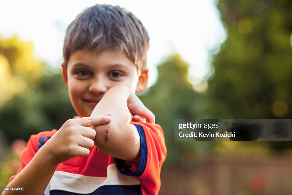 Boy pointing at bruise on elbow