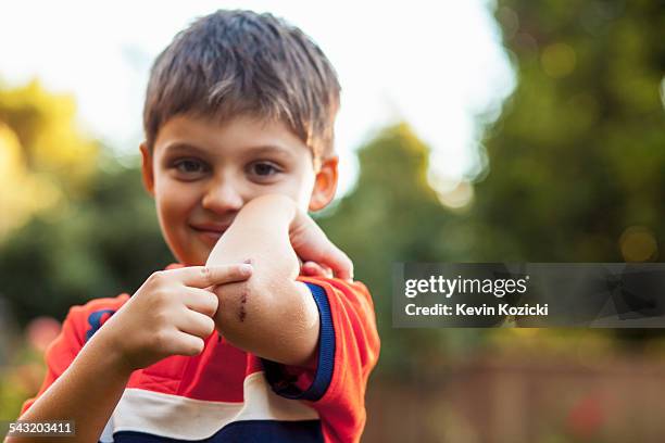 boy pointing at bruise on elbow - cardenal lesión física fotografías e imágenes de stock