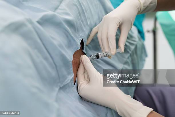 anesthesiologist inject medical solution to spinal - liquor stockfoto's en -beelden
