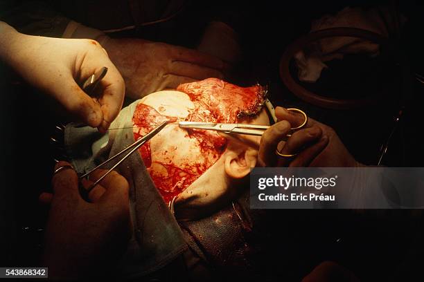 Three-year-old Italian Anna-Lisa undergoes the first of a series of open-cranium operations in hopes of repairing the massive facial malformations...