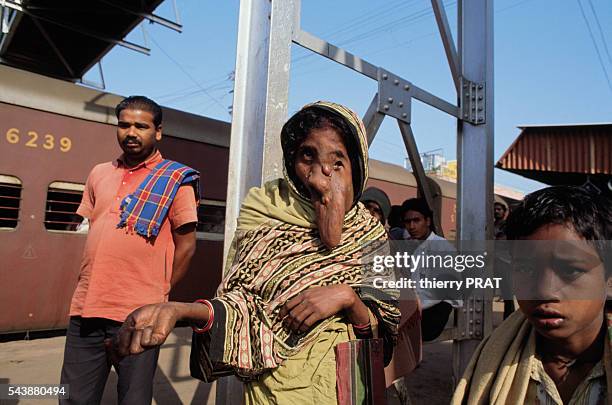 Woman suffering from elephantitis at a train station in Calcutta, India.
