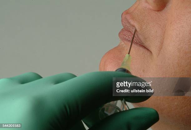 Schönheitsoperationen: Behandlung mit Botox, zur Verminderung von Falten, Vergrößerung der Lippen durch Unterspritzung