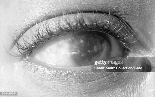 Photograph of a patient with congenital syphilis exhibiting interstitial corneal keratitis, 1966. This patient's congenital syphilitic disease...