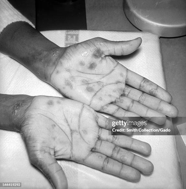 Patient with papulosquamous syphilids, or cutaneous eruptions of the disease, seen here on the wrist and palms, 1971. This patient presented with...