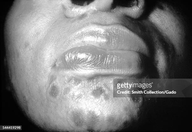 Photograph of a patient with secondary syphilis showing typical "nickel and dime" lesions on the face, 1971. A patient with typical "nickel and dime"...